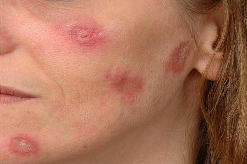 Диск рәвешендәге кызыл төче авыруы. Ул нидән гыйбарәт?