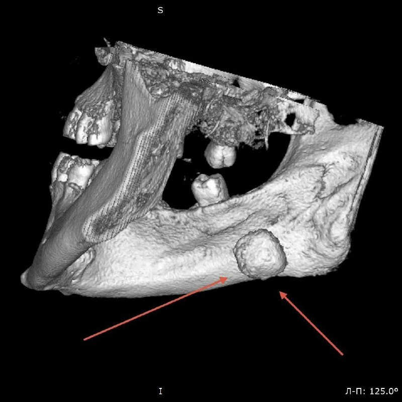 Пациент 17 ел төкерек бизендә таш "үстергән"