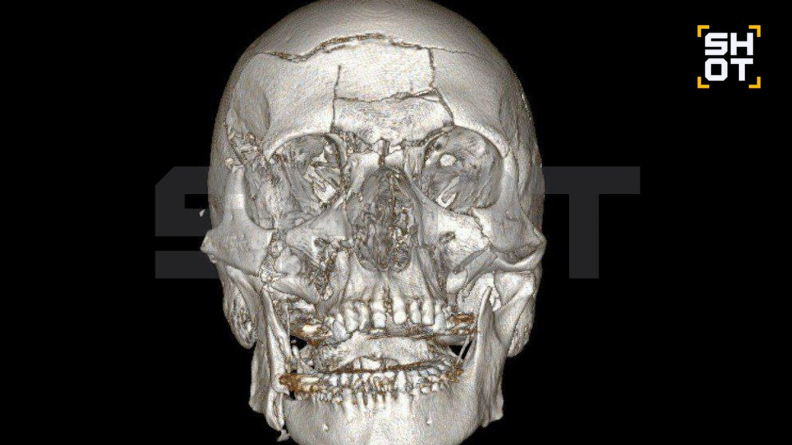 Баш сөяген берәмтекләп җыйганнар