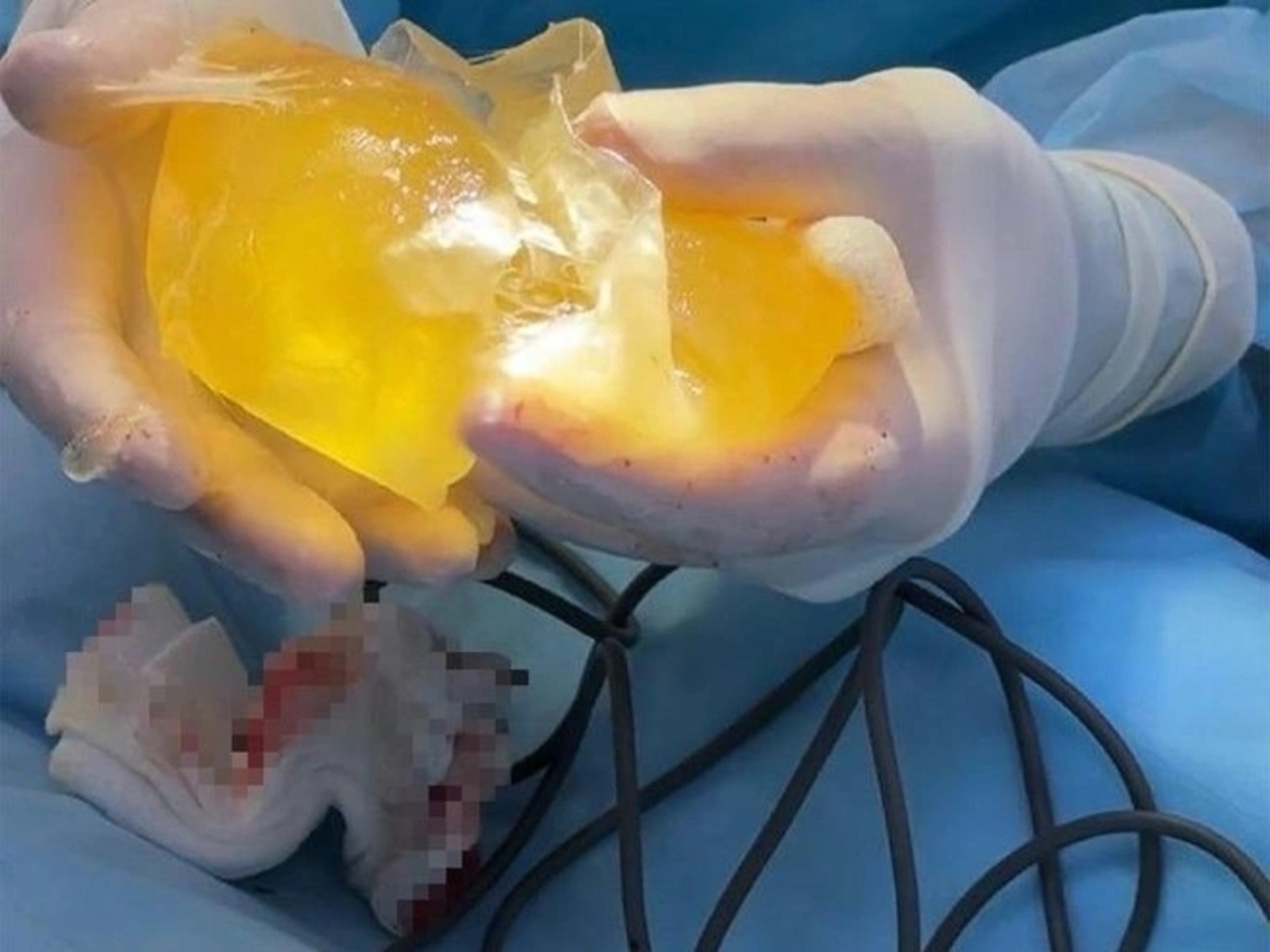 Уфа блогершасының күкрәгендә импланты шартлаган