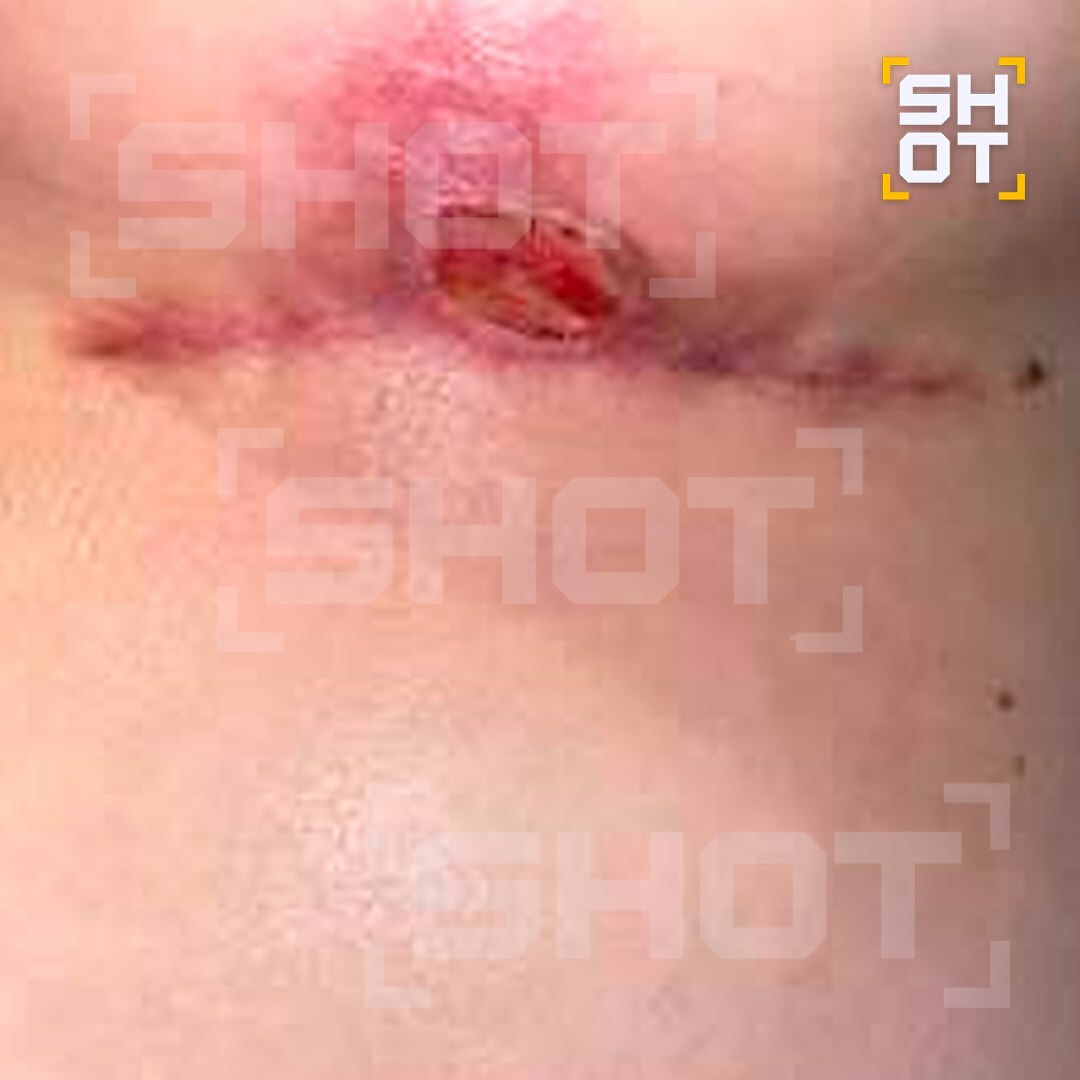 Күкрәк зурайтам дип рак чиренә җиткән...