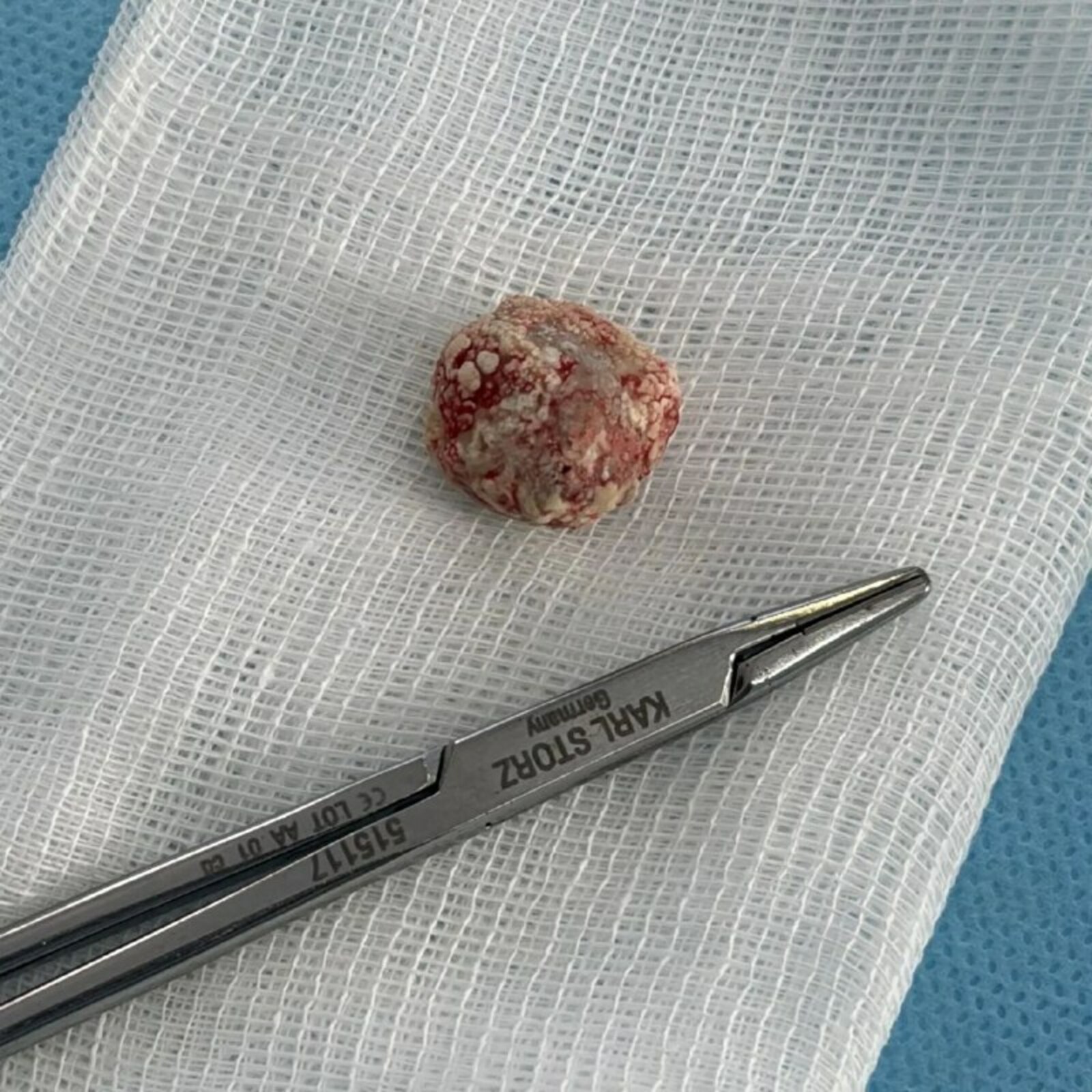 Пациент 17 ел төкерек бизендә таш "үстергән"