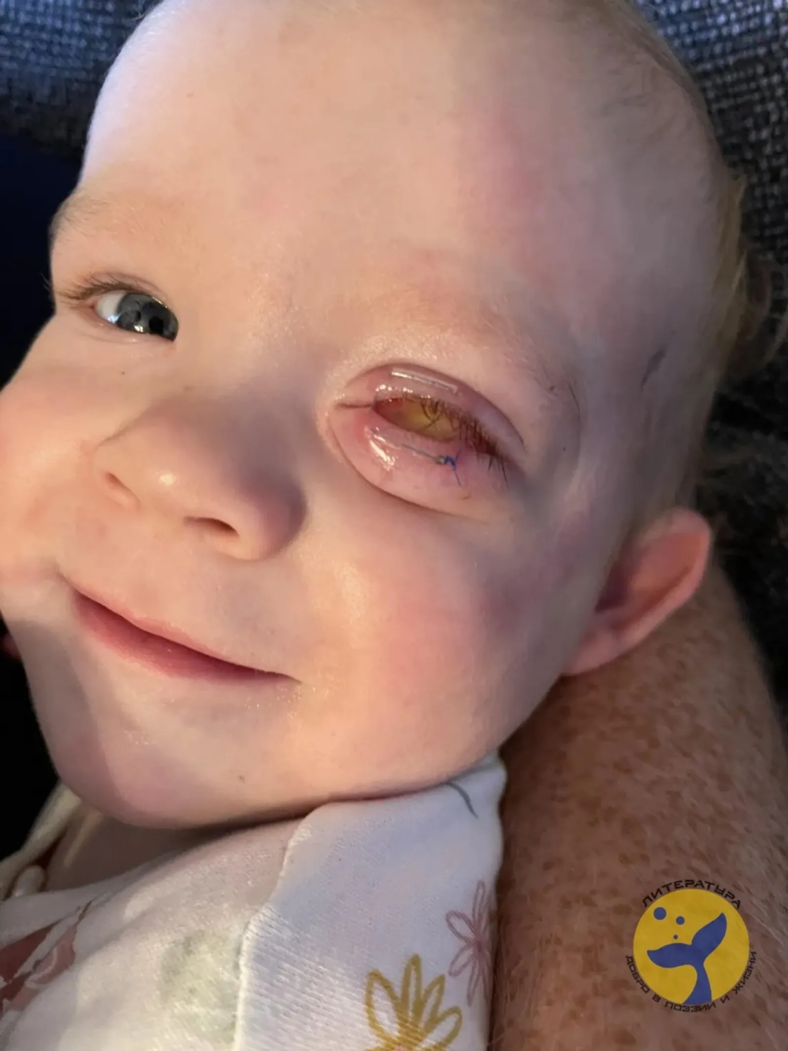 Дүрт айлык кызның күзендә рак тапканнар