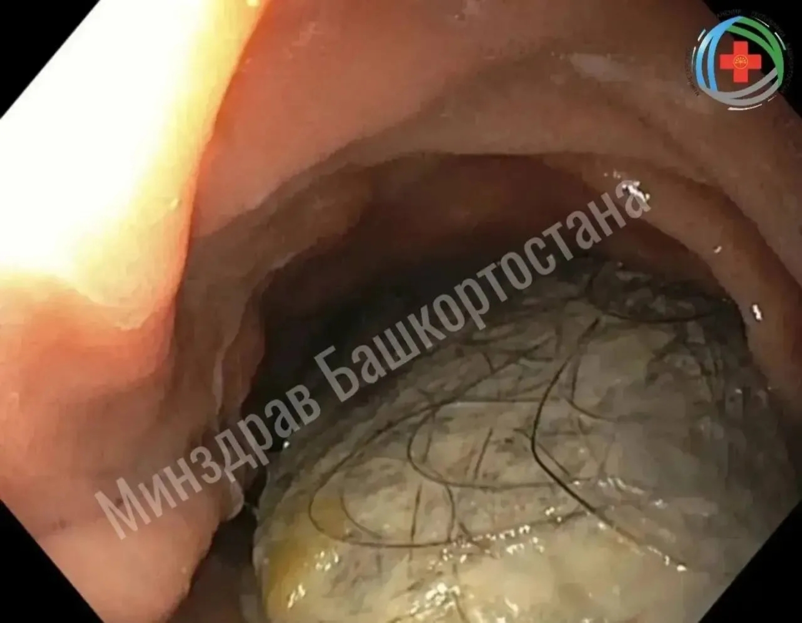 Табиблар кызның ашказаныннан чәч йомгагын алган