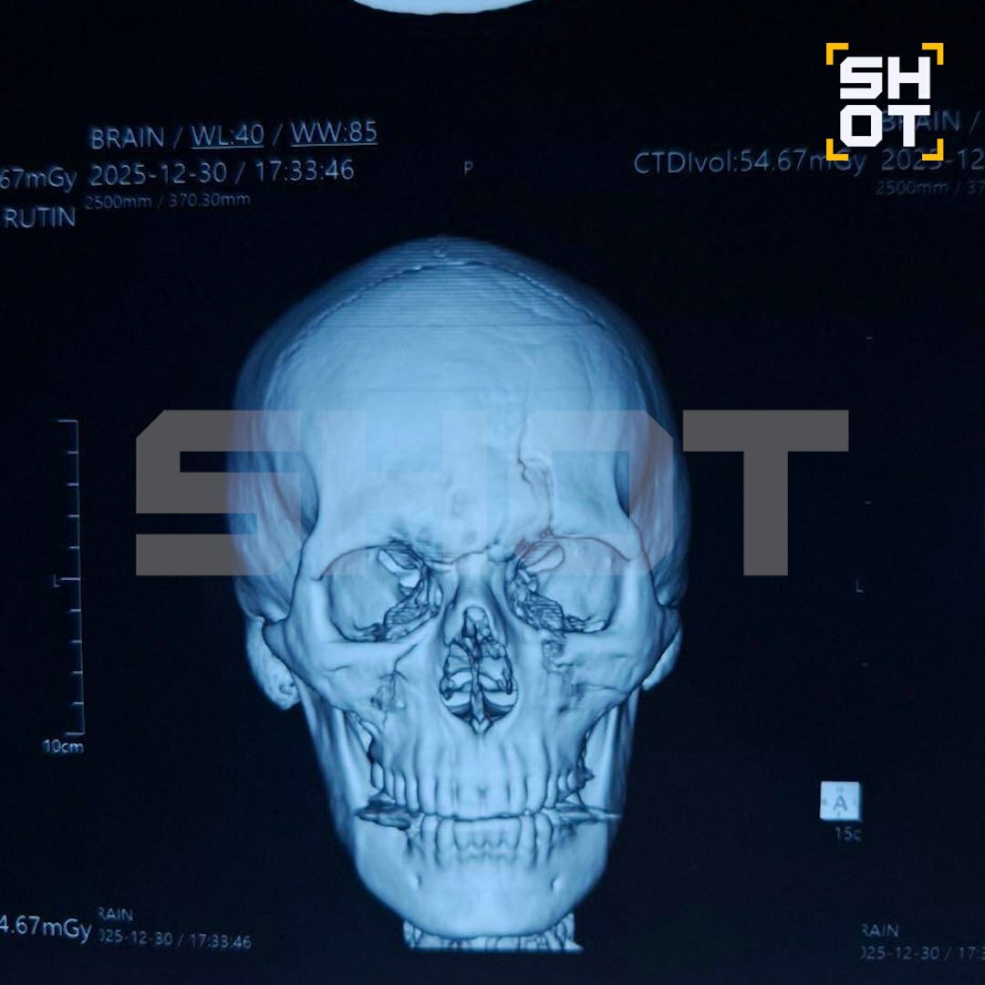 Русиялене Бали утравында паралич "суккан"