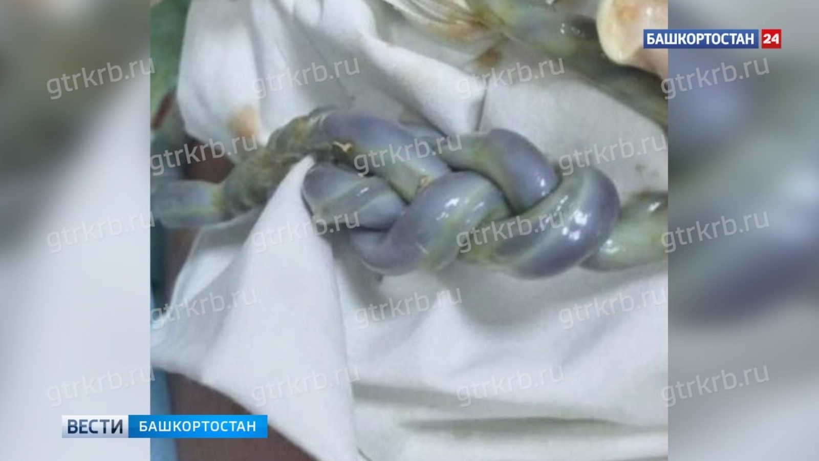 Гаҗәп хәл: Уфада кендеге толым кебек  үрелгән сабый туган