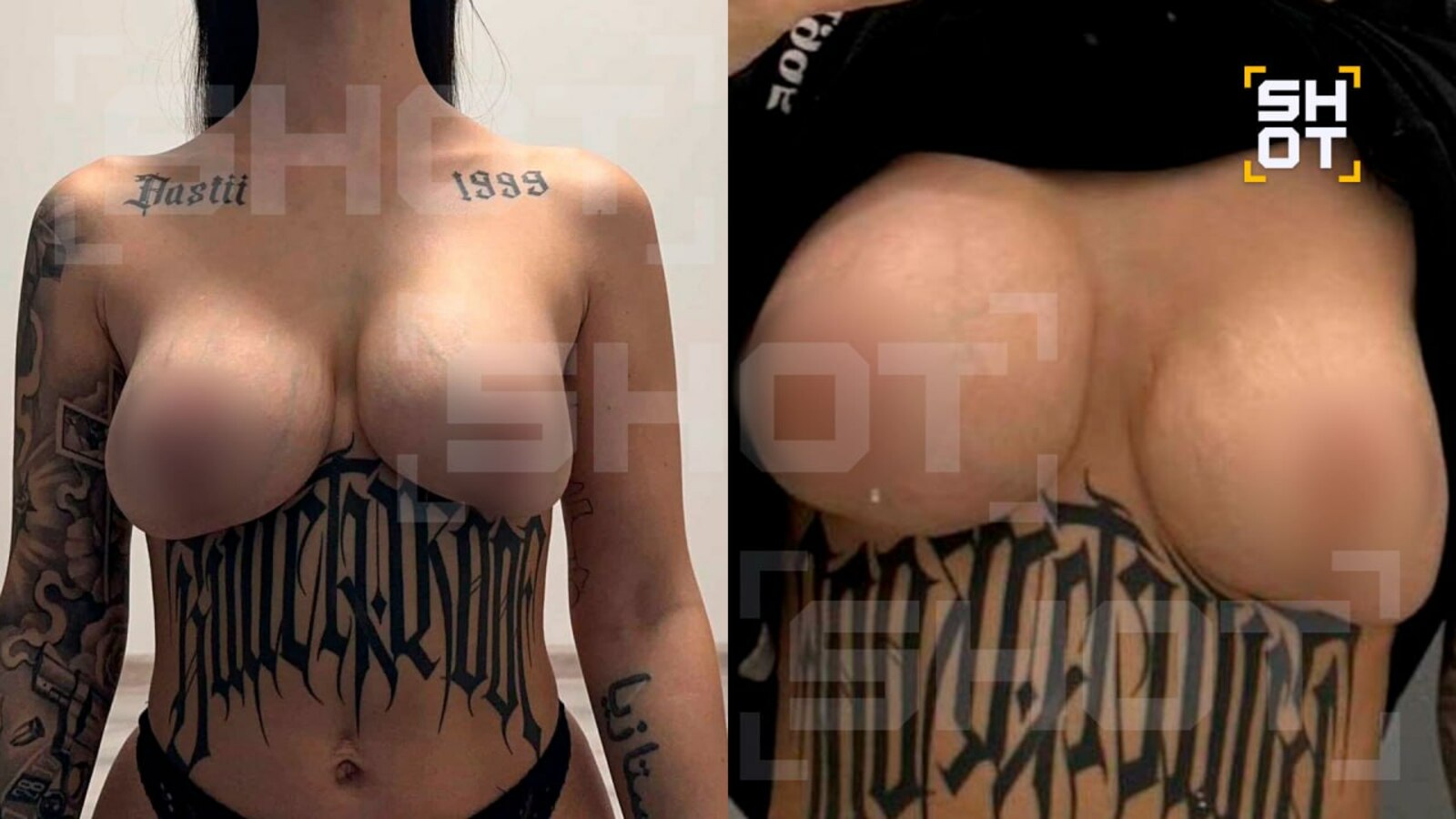 Күкрәк зурайтам дип рак чиренә җиткән...