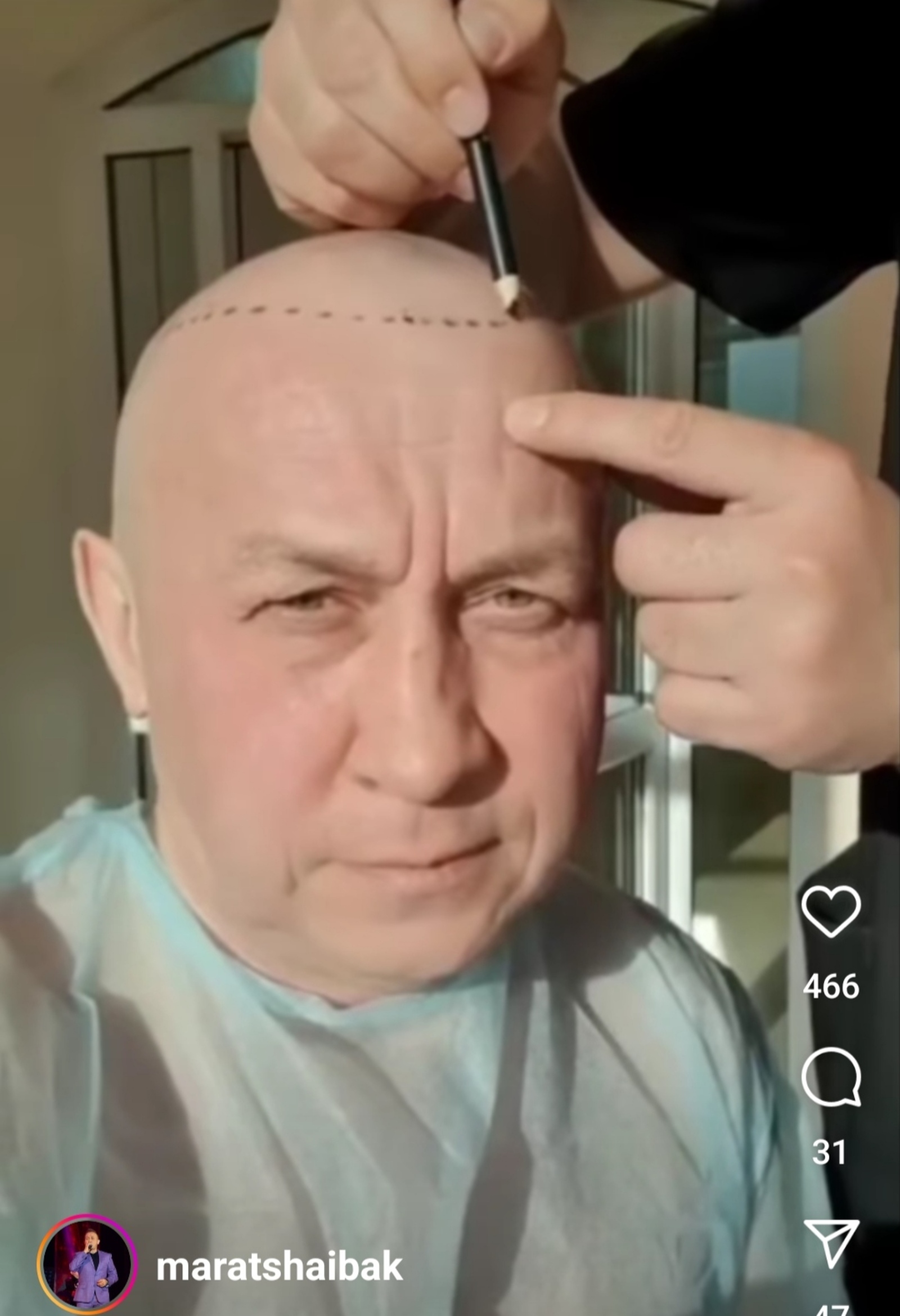 Марат Шәйбәков чәч күчереп утырту буенча операция ясаткан