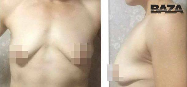 Уфа клиникасында күкрәк "үстергән" һәм...